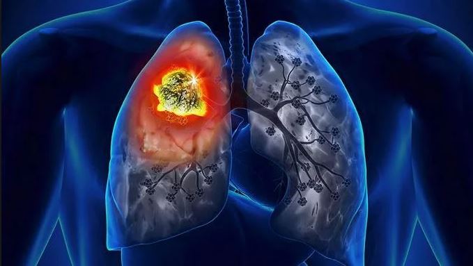 Un análisis de sangre podría mejorar la detección precoz del cáncer de pulmón